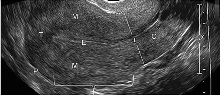 Normal sag uterus ultrasound